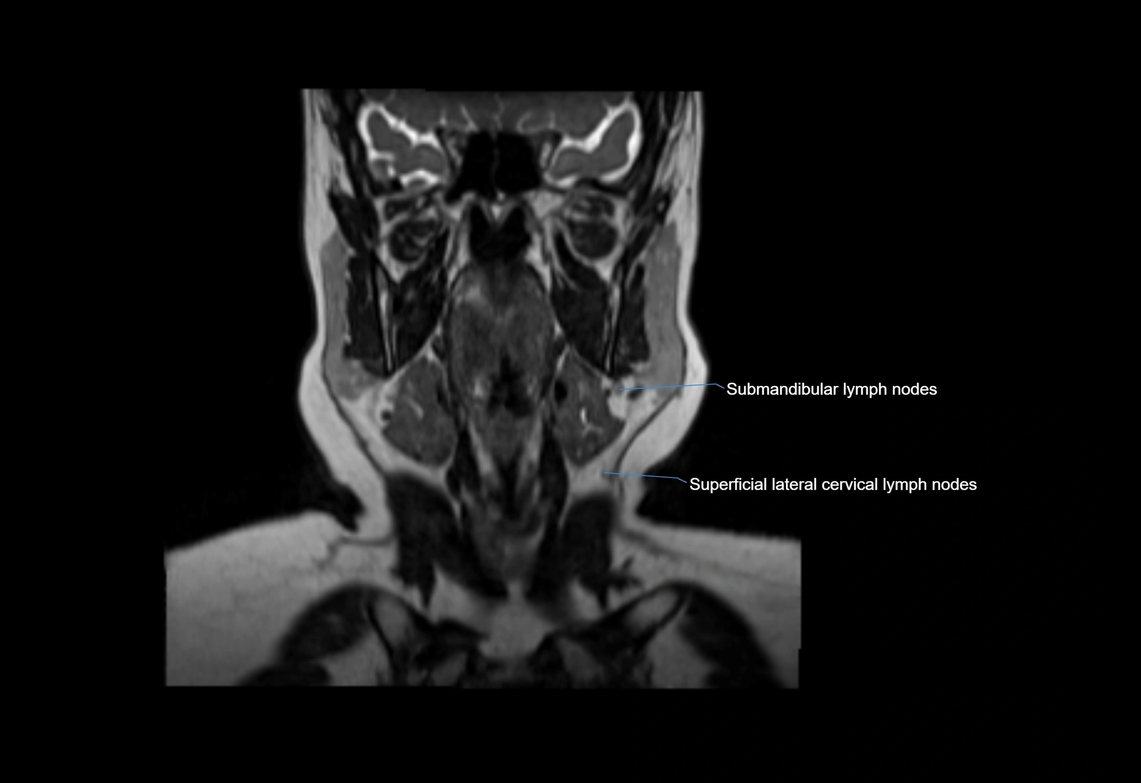 Neck coronal lymph node cross sectional MRI anatomy 3T MRI  image-img-00001-00047.webp
